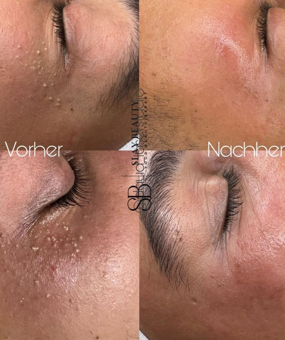 Microneedling & Aquafacial