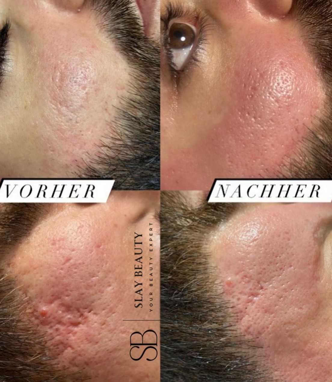 Microneedling & Aquafacial