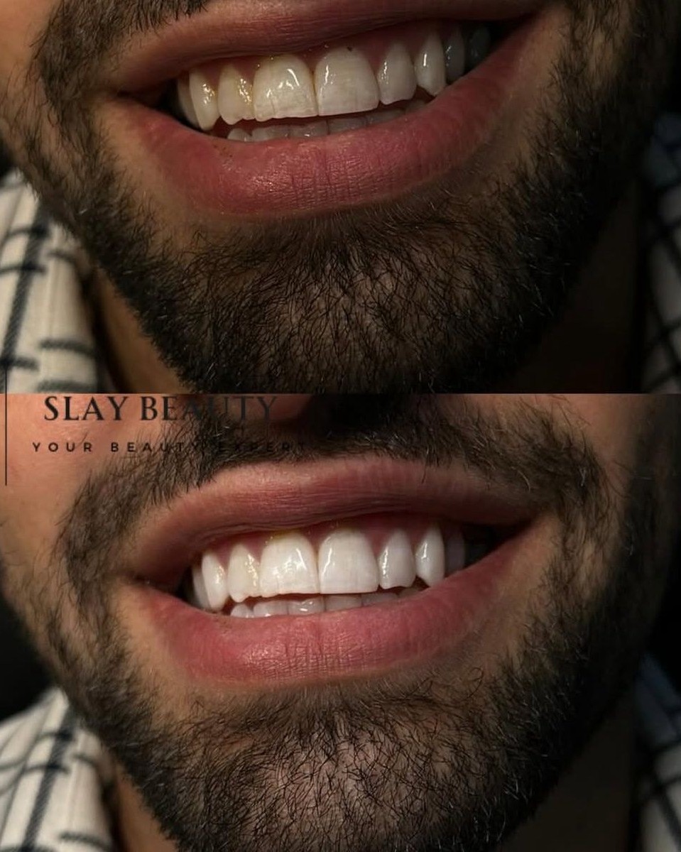 Bleaching & Tooth Gems