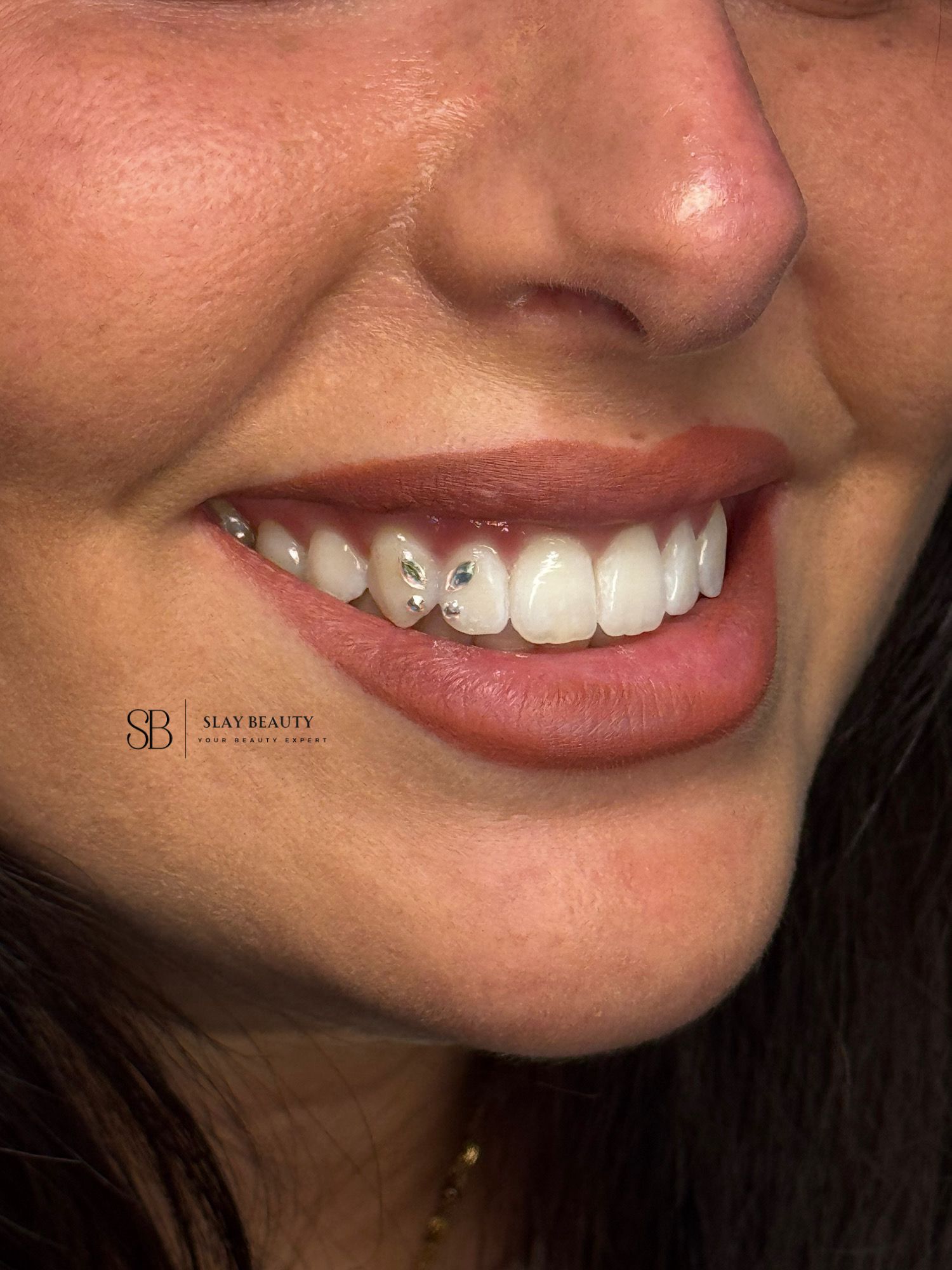 Bleaching & Tooth Gems