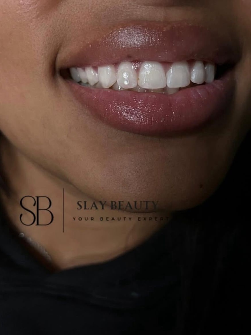 Bleaching & Tooth Gems